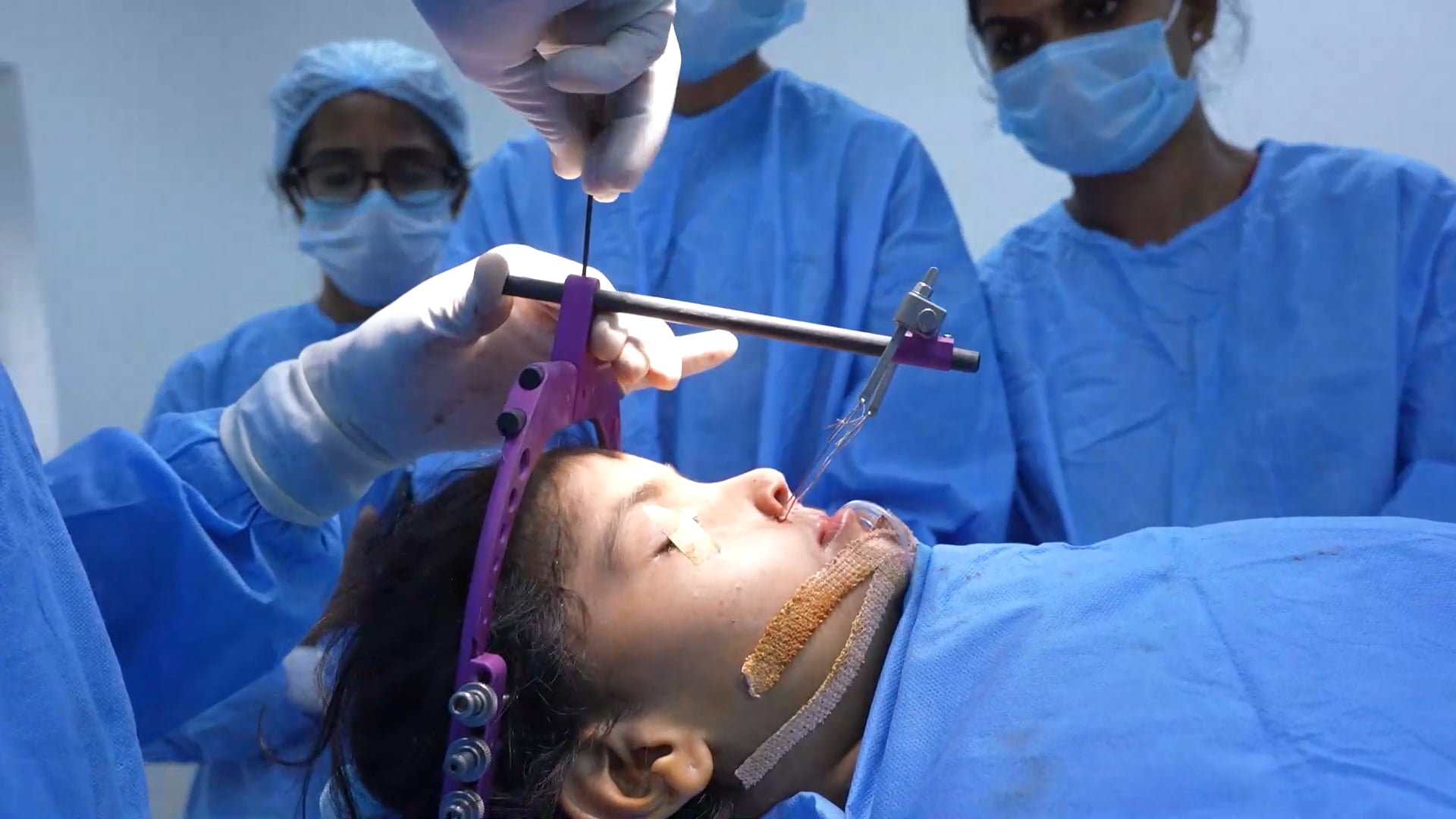 Halo Martin Lefort 1 Distraction Surgery